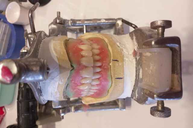 قالب گيري و ساخت دندان مصنوعي پروتز دنچر در منزل
