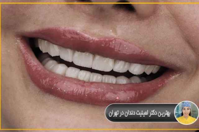 بهترين دكتر لمينيت دندان در تهران